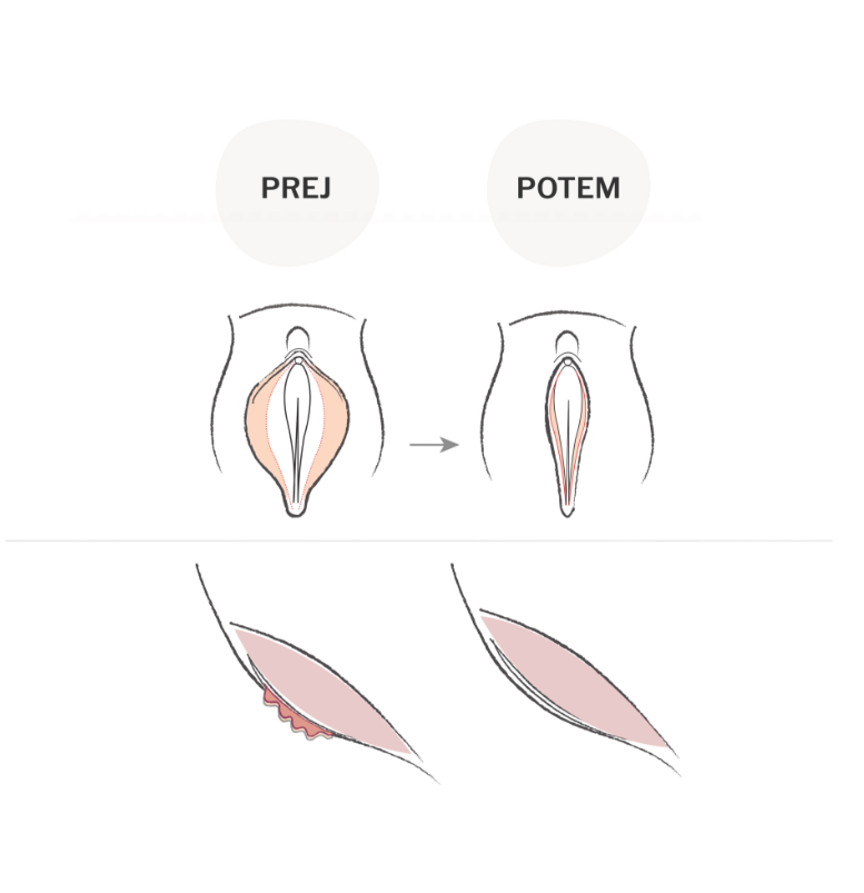 labioplastika potek