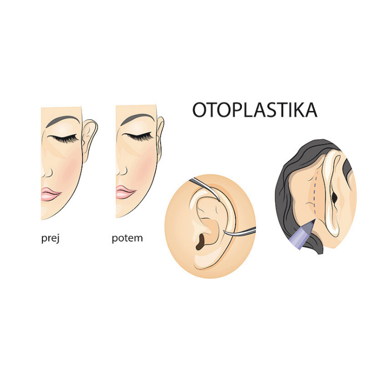 potek otoplastike