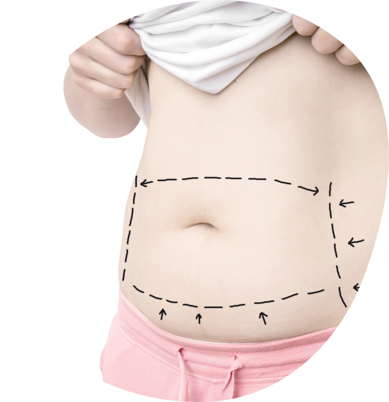 abdominoplastika poseg