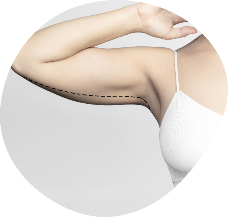 brahioplastika-za-koga-primerna